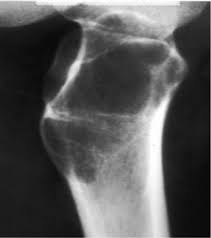 <p>An aneurysmal bone cyst is not a true neoplasm or cyst. \n consists of numerous blood-filled, arteriovenous communications thought to be caused by trauma.</p>