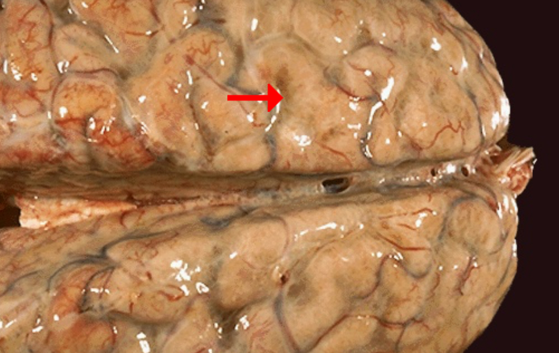 <ol><li><p>Identify morphologic pattern of acute inflammation</p></li><li><p>What could be the underlying cause of the disease leading to accumulation of the pointed fluid?</p></li><li><p>Possible effects on affected individual</p></li><li><p>Preponderant cell if CSF samples are obtained</p></li></ol><p></p>
