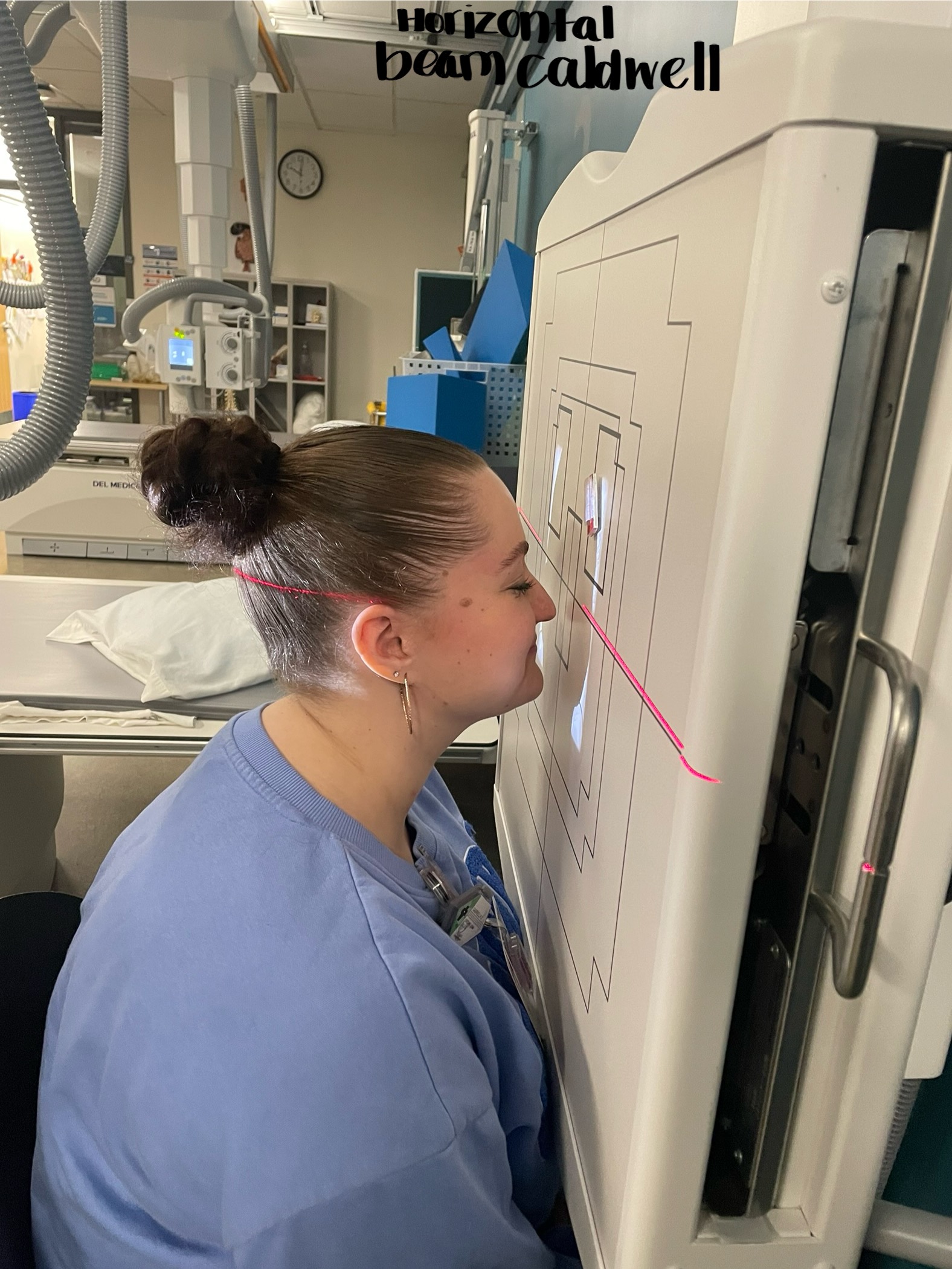 <p>Pt position: PA. Chin up 15 degrees from OMBL (looks like tip of nose touching board) </p><p>CR entrance/exit: nasion </p><p>tube angle: none</p><p>SID: 40”</p><p>Size IR : 10× 12 </p><p>Collimation: Can cut off top of cranium and chin. Minimal light past ears. </p><p>Breathing: suspend</p><p>Anatomy? All sinuses demonstrated. Petrous ridges fill lower 1/3 of orbits. </p>