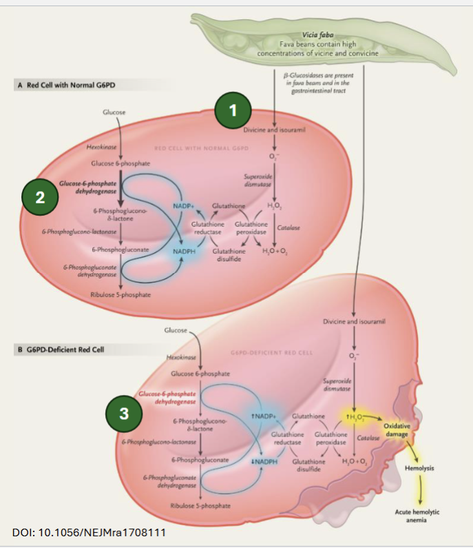 <p>Non-immune hemolytic anemia </p><p>Fava bean glycosides are hydrolyzed into divicine and isouramil → can generate ROS (ie. H<sub>2</sub>O<sub>2</sub>), which is sequestered by GSH in cells with <strong>normal G6PD activity</strong> (NADPH regenerates GSH)</p><p>In cells with <strong>reduced G6PD activity</strong>, NADPH production is limited → insuffiient regeneration of GSH → oxidative damage → hemolysis</p>