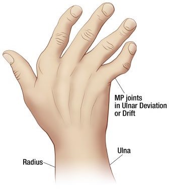 <p>ulnar deviation</p>