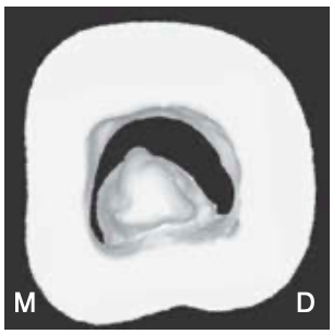 <p><span>a </span><span style="color: red;"><span>peninsula-like</span></span><span> floor with continuous C-shaped orifice</span></p>