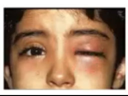 <p>orbital cellulitis </p>