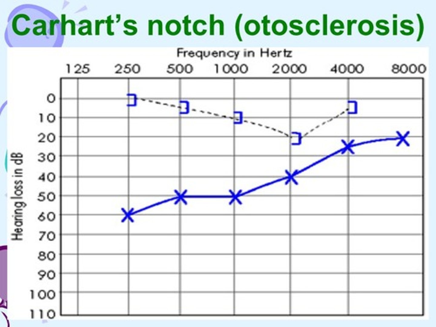 <p>A conductive HL that typically occurs with a notch at around 2 KHz. on the audiogram (the air-bone gap is smallest at 2 KHz.)</p>