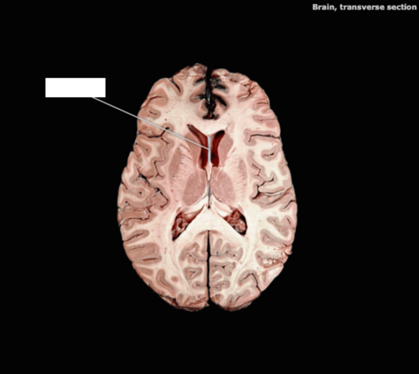 <p>ID structure that separates lateral ventricles</p>