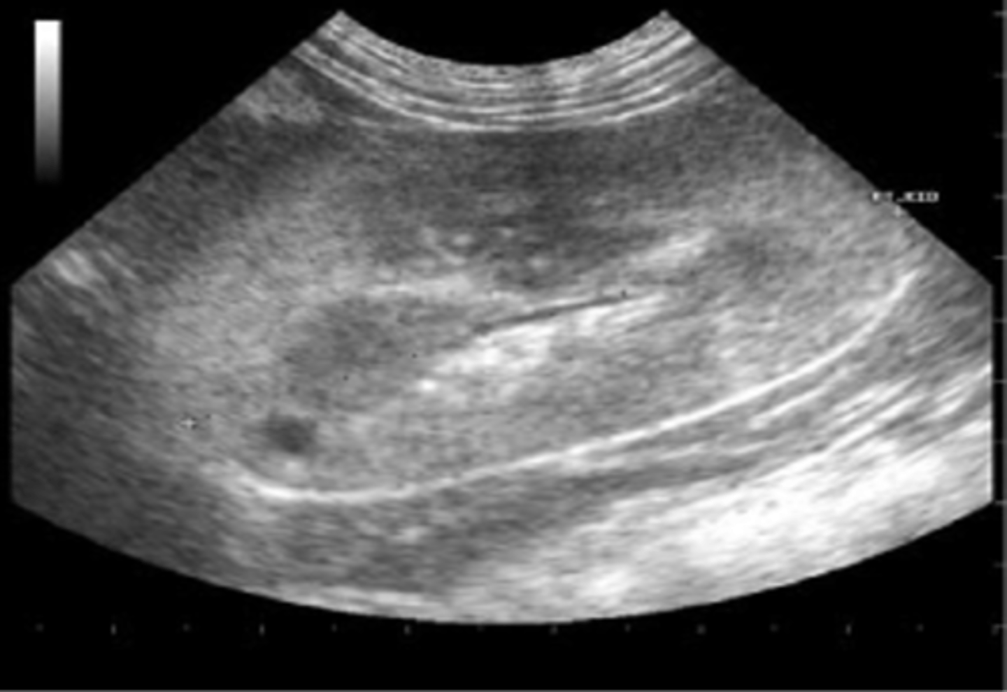 <p>Acute glomerulonephritis is seen sonographically with increased ___ echoes </p>