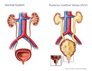 <p>obstructive membranes that develop in the urethra (tube that drains urine from the bladder), close to the bladder</p><p>valve can <strong>obstruct or block the outflow of urine through the urethra</strong>.</p>