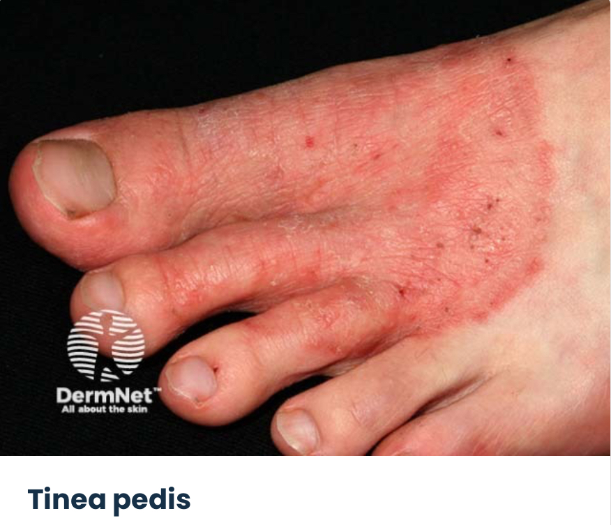 <ul><li><p>plăci pruriginoase, scuamoase, eritematoase</p></li></ul><ul><li><p>margini elevate si centru clar (margine active si atenuare centrala)</p></li></ul>