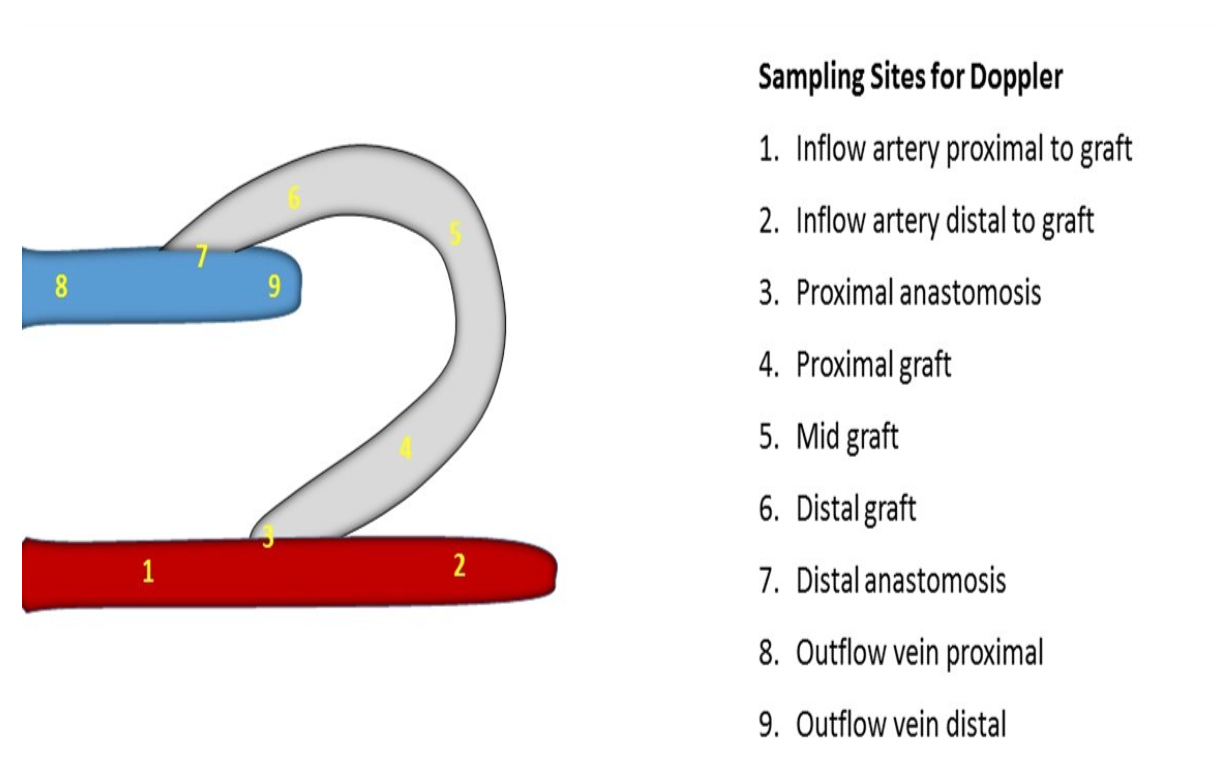 <ol><li><p>Inflow artery proximal and distal to graft </p></li><li><p>Arterial or proximal anastomosis</p></li><li><p>Graft</p></li><li><p>Venous or distal anastomosis</p></li><li><p>Outflow vein proximal and distal to graft </p></li></ol><p></p>