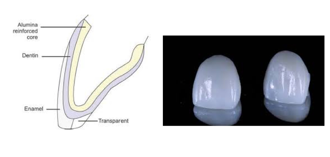 <p>Ceramics with alumina crystals in a glass matrix</p><p>McLean’s technique used a 50% alumina core veneered with porcelains making restorations ~40% stronger than feldspathic porcelain</p>