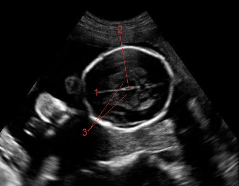 <p>what is #2</p><p>a) fourth ventricle</p><p>b) caudate nucleus</p><p>c) third ventricle </p><p>d) corpus callosum</p>