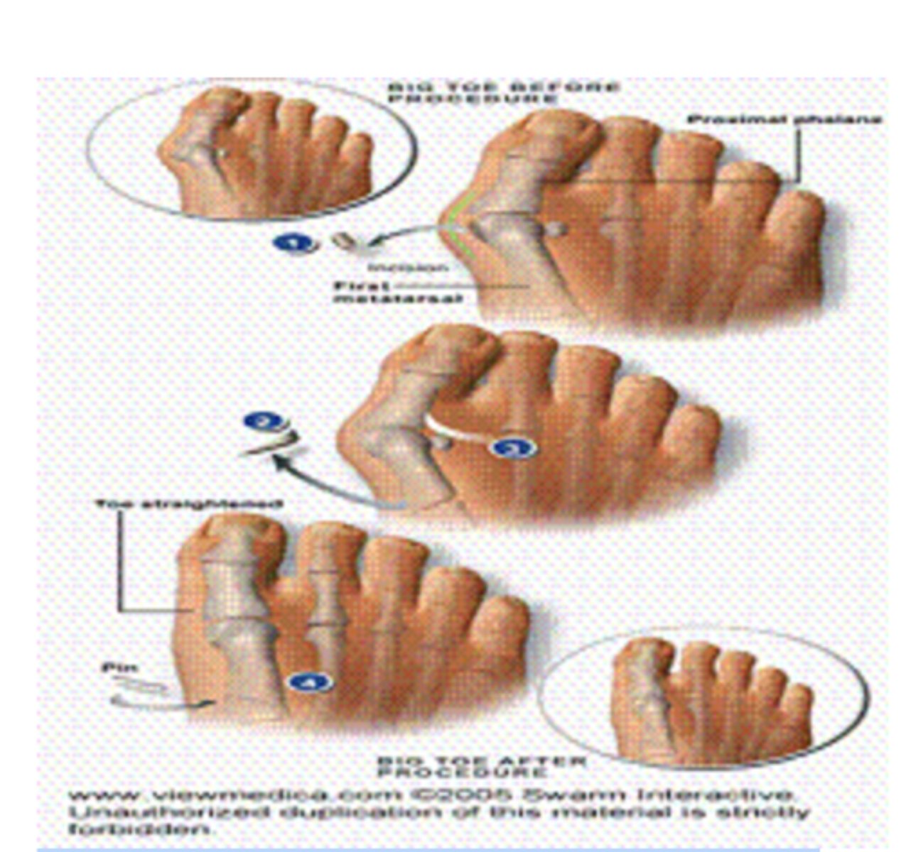 <p>This picture shows hammer toe.</p><p>(T/F)</p>