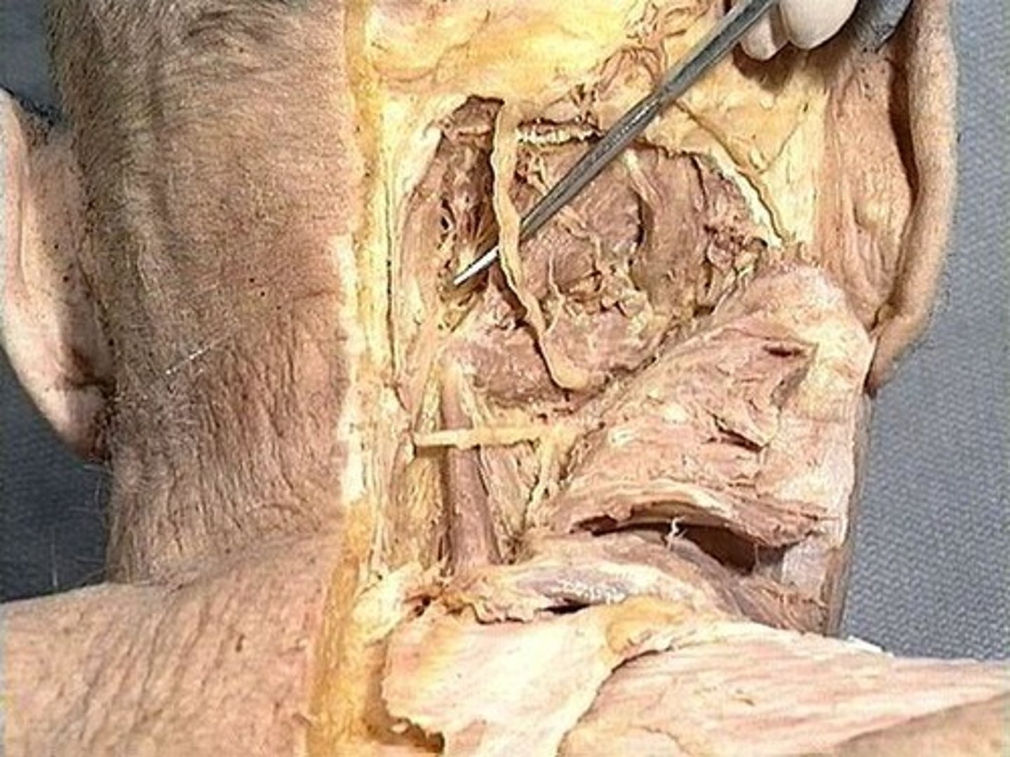 <p>posterior ramus of C2, innervates scalp</p>