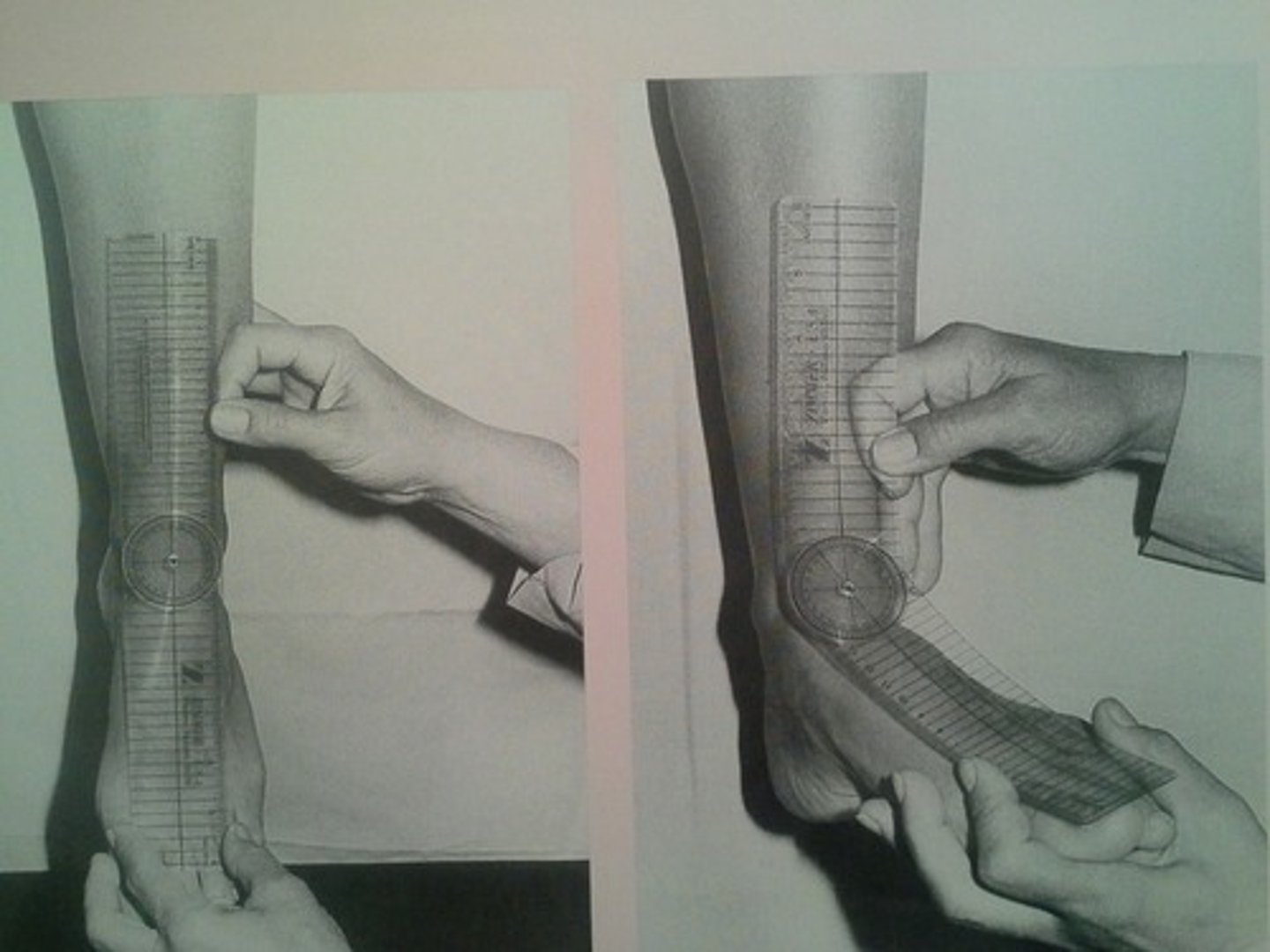 <p>fulcrum: anterior aspect of ankle a few centimeters distal to malleolus<br>proximal: anterior midline shank<br>distal: anterior midline 2nd MC<br><br>* stabilize calcaneus<br>* normal = 15</p>