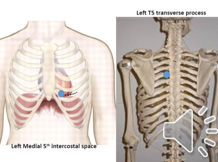 <p>anterior point: left medial 5th intercostal space<br>posterior point: left L5 transverse process</p>