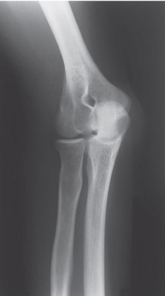 <p>radial head articulation with humerus</p>