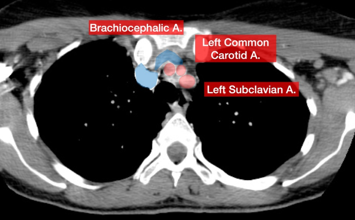 <ul><li><p>Brachiocephalic (RT)</p><ul><li><p>RT subclavian → RT vertebral</p></li><li><p>RT common carotid → RT ICA and ECA</p></li></ul></li></ul><ul><li><p>LT common carotid → LT ICA and ECA</p></li><li><p>LT subclavian → LT vertebral</p></li></ul><p></p>