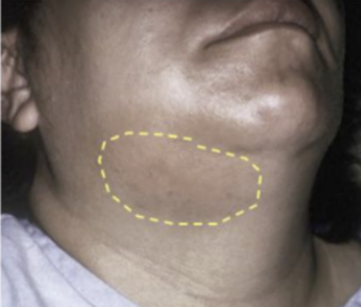 <p>If a patient demonstrates swelling such as that seen in the provided image, where do you anticipate the infection to be located?</p><p>a. submental space</p><p>b. submandibular space</p><p>c. sublingual space</p><p>d. mental space</p><p>e. cervical space</p>