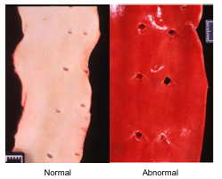 <p>Heme part of hemoglobin from vasodilation, hemorrhage, or hemoglobin imbibition</p>