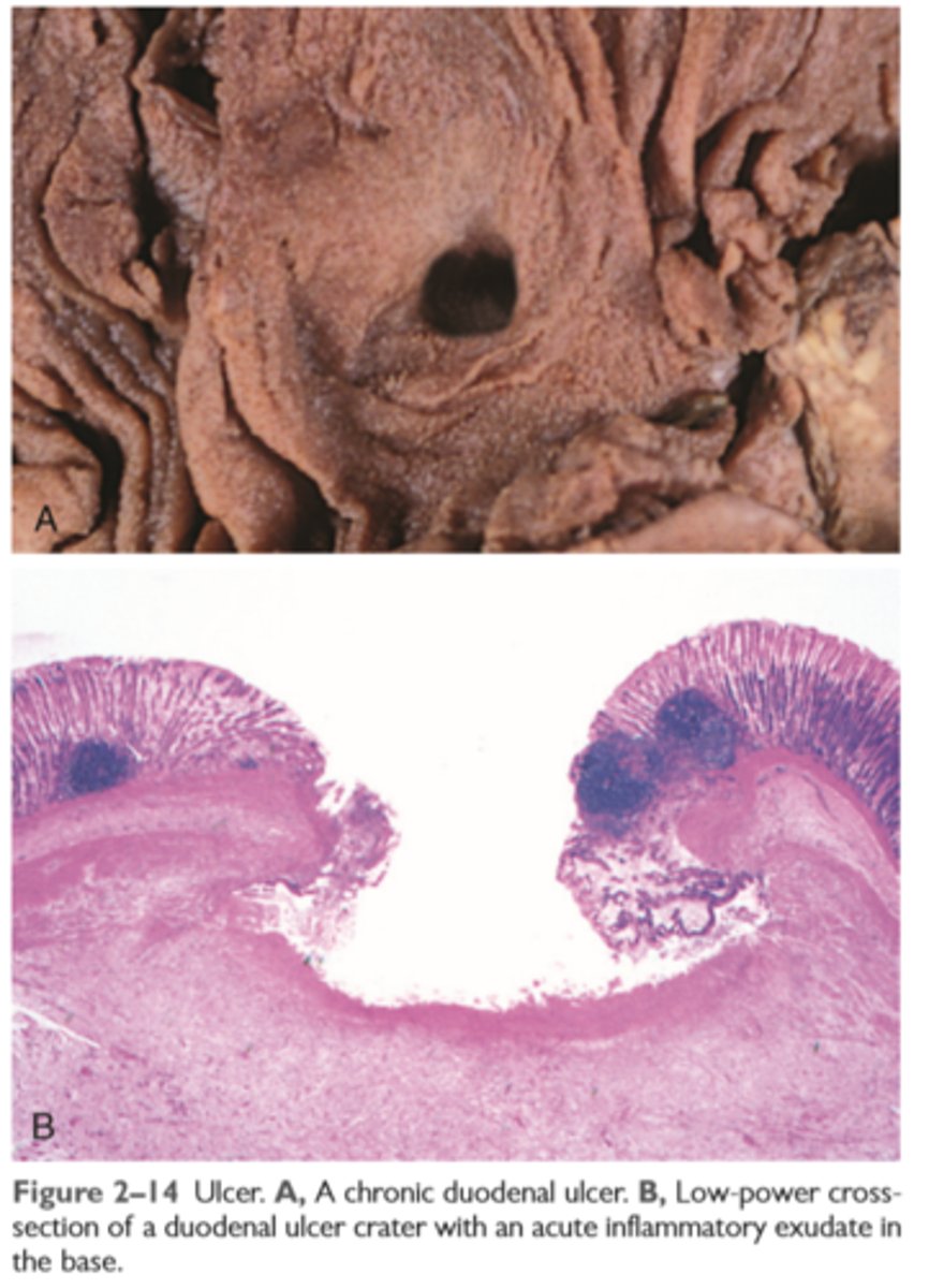 <p>is a local defect, or excavation, of the surface of an organ or tissue that is produced by necrosis of cells and sloughing (shedding) of necrotic and inflammatory tissue</p><p>Ulceration can occur only when tissue necrosis and resultant inflammation exist on or near a</p><p>surface</p><p>Ulcers are most commonly encountered in (1) the mucosa of the mouth, stomach, intestines, or genitourinary tract and (2) in the subcutaneous tissues of the lower extremities in older persons who have circulatory disturbances predisposing affected tissue to extensive necrosis</p><p>Ulcerations are best exemplified by peptic ulcer of the stomach or duodenum, in which acute and chronic inflammation coexist. During the acute stage, there is intense polymorphonuclear infiltration and vascular dilation in the margins of the defect. With chronicity, the margins and base of the ulcer develop scarring with accumulation of lymphocytes, macrophages, and plasma cells</p>