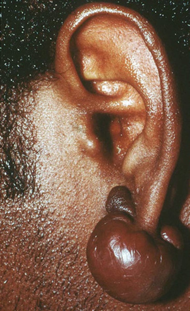 <p>Overgrowth of scar tissue</p><p>Dt: Trauma</p><p>On ear lobe/cartilaginous area</p><p>On/around area of trauma</p>