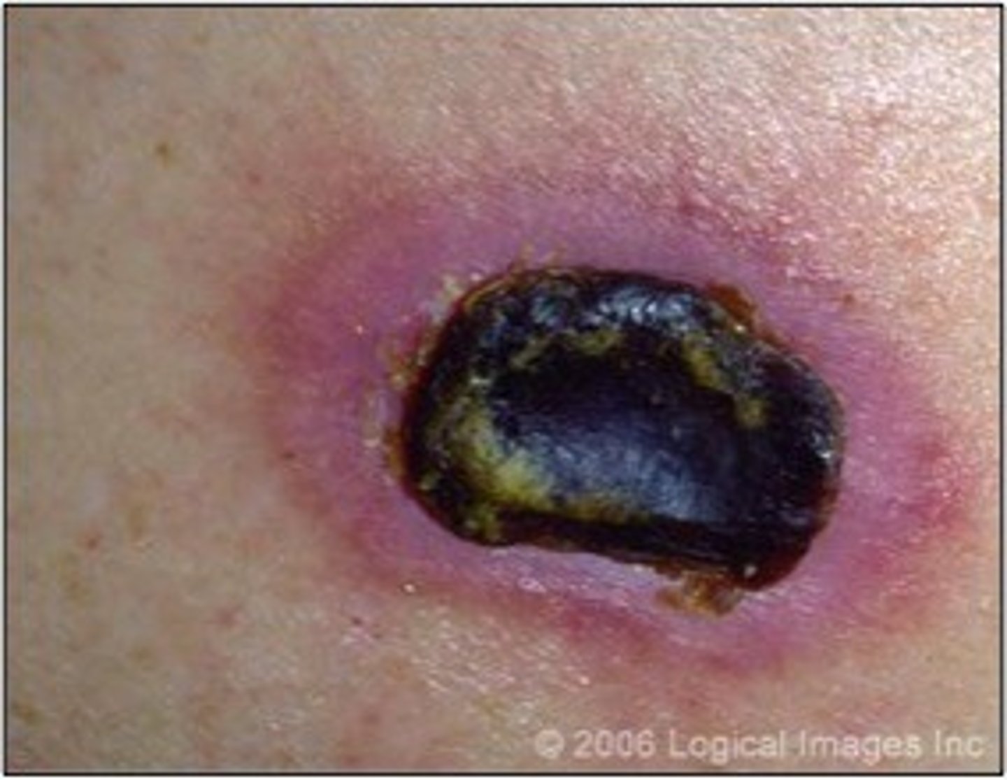 <p>dead (necrotic) tissue that forms over healthy skin and then over time falls off (sheds)</p>