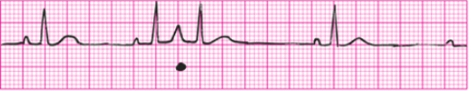 <p>Premature atrial complex criteria</p>