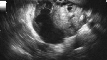<p>Malignant Mucinous Cystic Adenoma (AKA cystadenocarcinoma)</p>