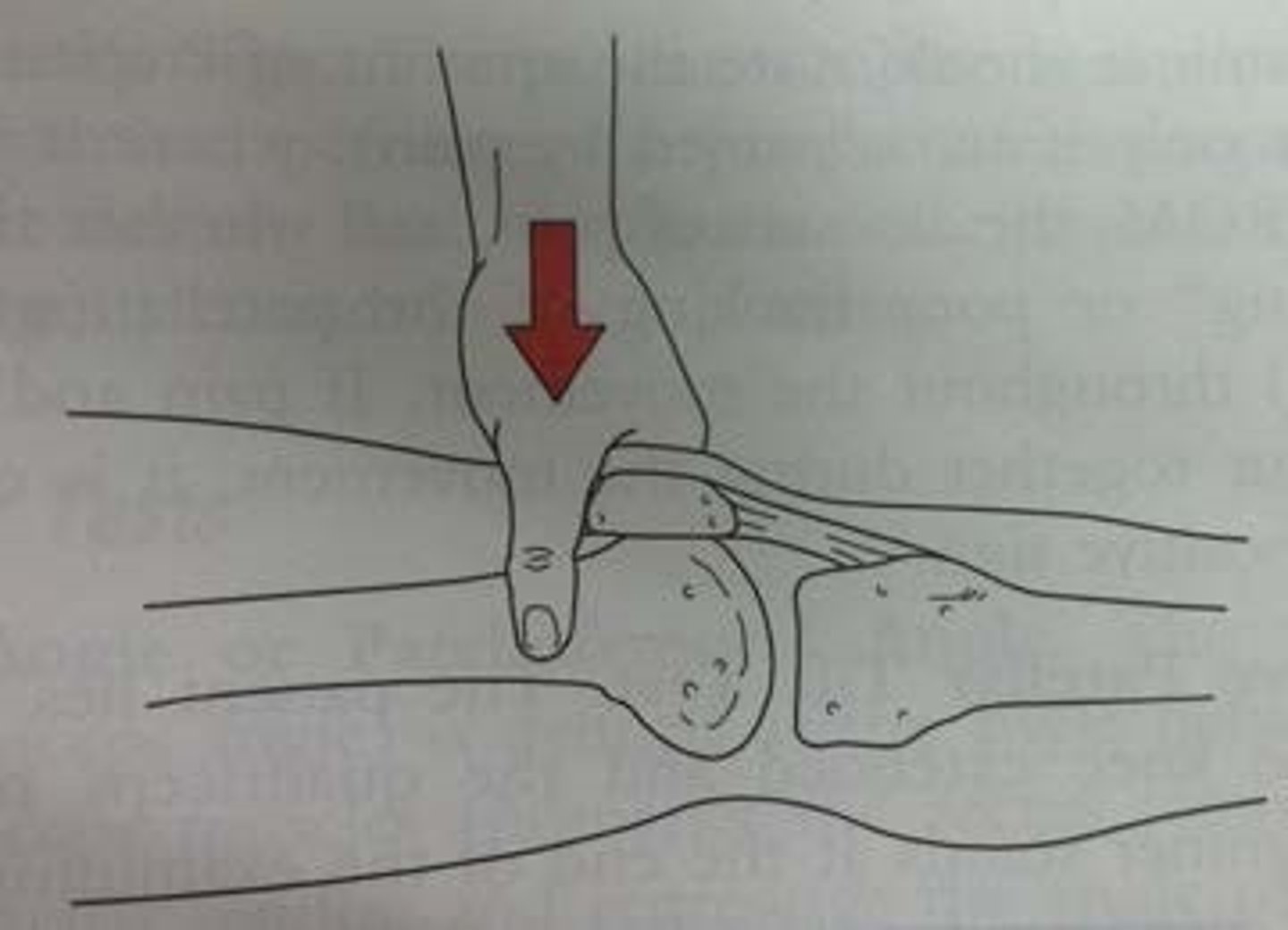 <p>Patellofemoral dysfunction</p>