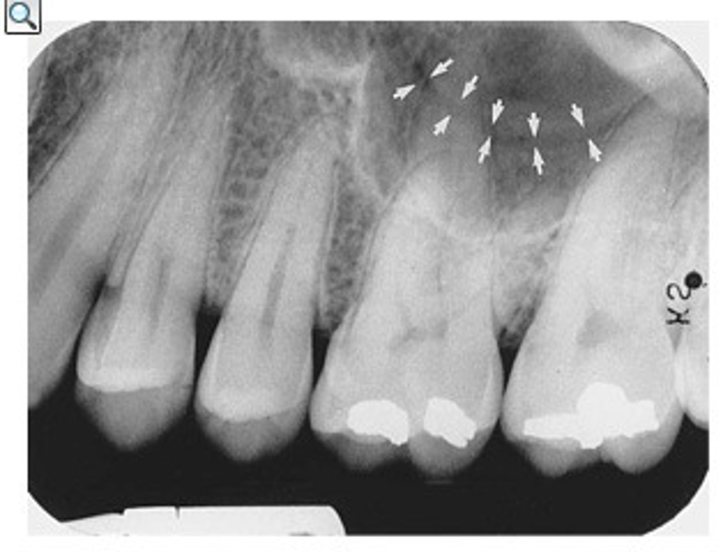 <p>What is the radiolucent structure seen here?</p>