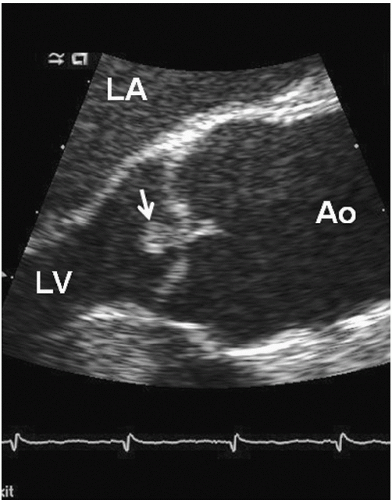 <p>Small, fibrous thickening on the free edges of semilunar valves.</p><p>Typically seen on the aortic valve.</p><p>Can be mistaken for a mass.</p>