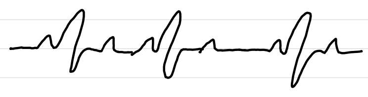 <ul><li><p>rate: <60-100 bpm</p></li><li><p>rhythm: <span style="color: red;">irregular</span></p></li><li><p>P waves: normal</p></li><li><p>PR interval: 0.12-0.20 sec</p></li><li><p>QRS complexes: <0.10 sec</p></li><li><p>ST segments: normal</p></li></ul><p></p>