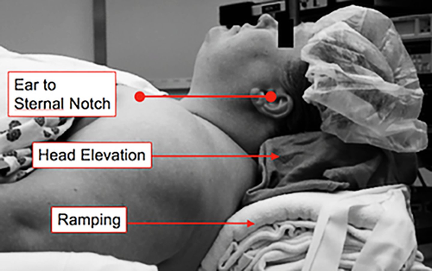 <p>ear to sternal notch alignment</p>