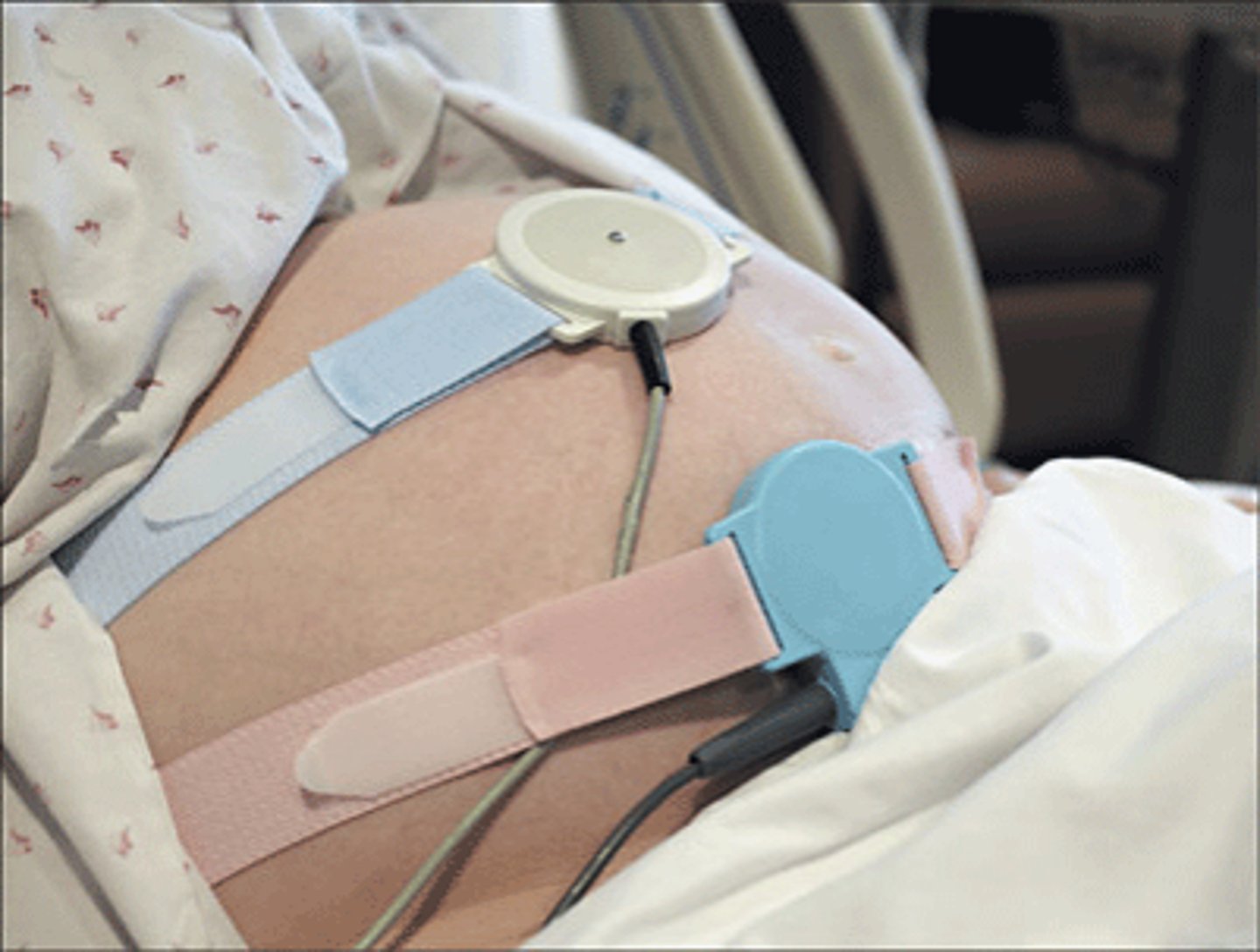 <p>-measures FHR </p><p>-found in lower abdomen</p><p>-secured on the mother's abdomen with elastic straps</p><p>-less accurate than internal devices but are noninvasive and suitable for most women in labor</p>