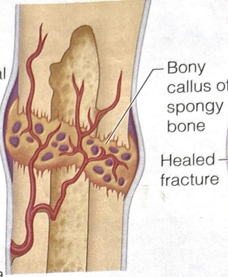 <p>third stage of bone fracture healing</p>