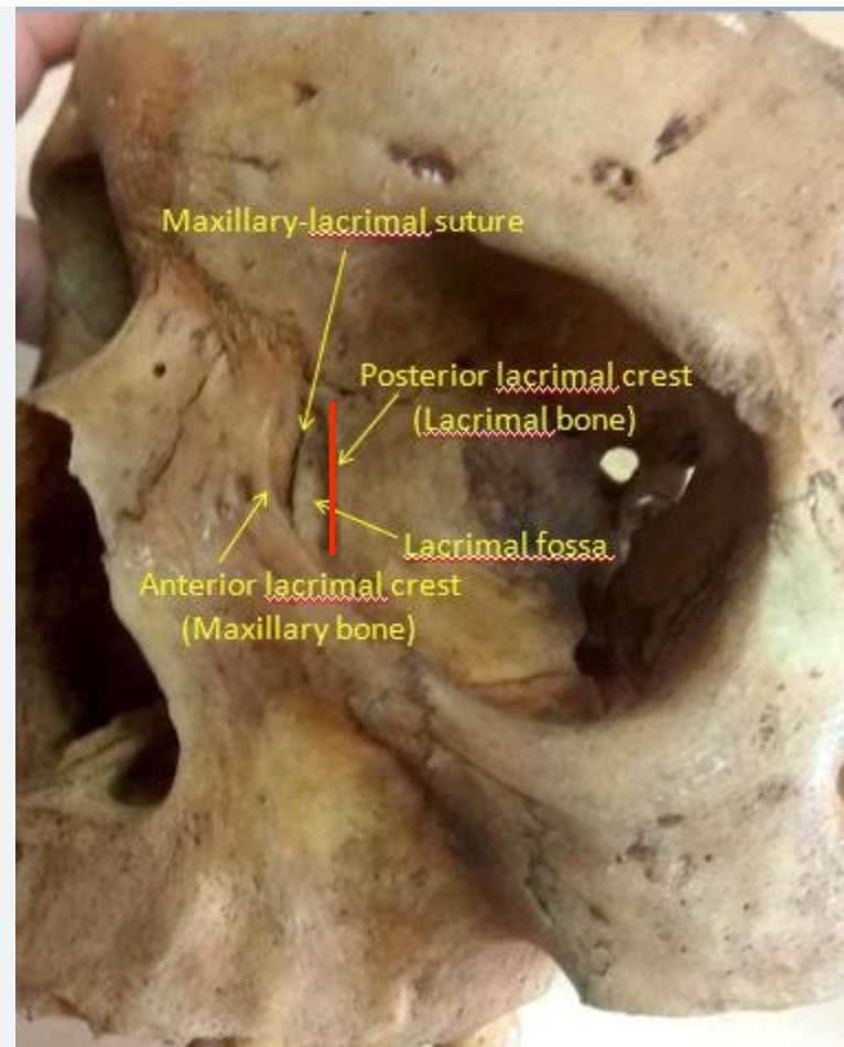 <p>ridge in the middle of the lacrimal bone </p><p>posterior to nasolacrimal canal </p>