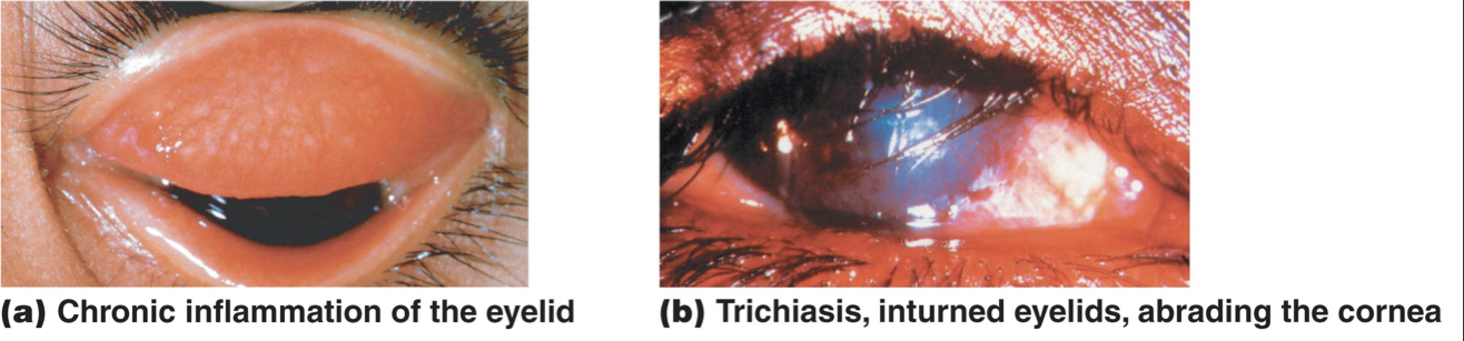 Trachoma: (Bacterial diseases of the eye)