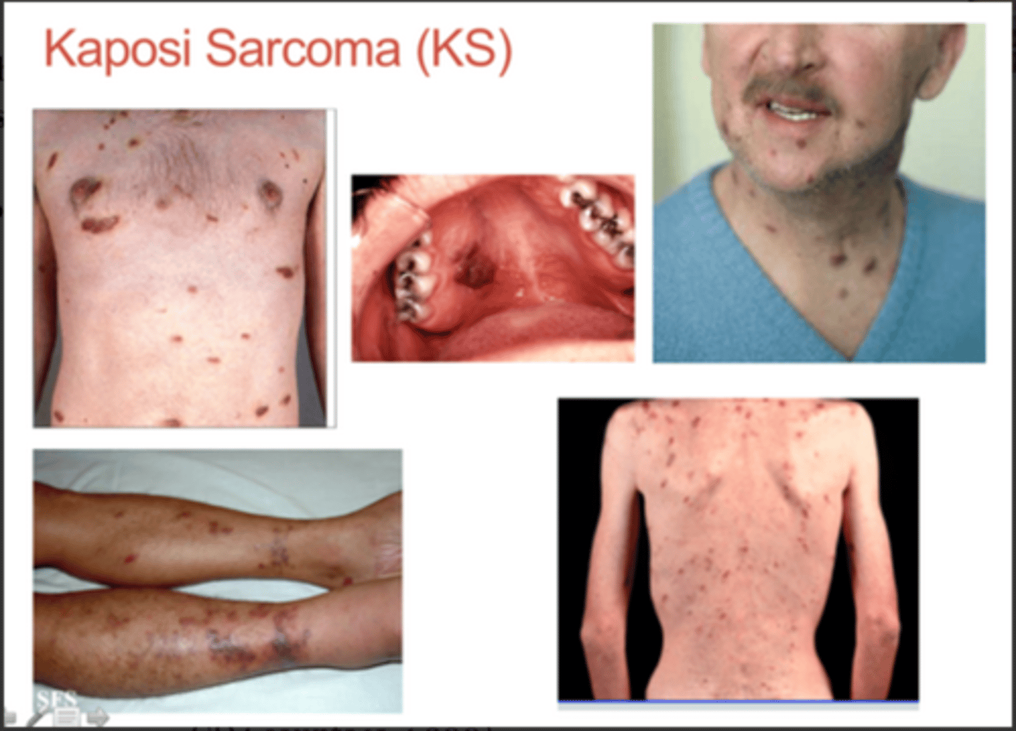 <p>Kaposi sarcoma</p>