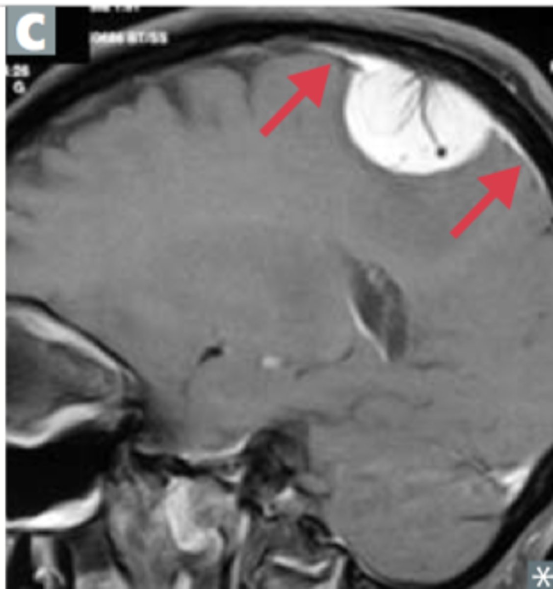 <p>compression causes cerebral edema</p><p>- headache</p><p>- vomiting</p><p>- seizure</p><p>-behavioral issues</p>