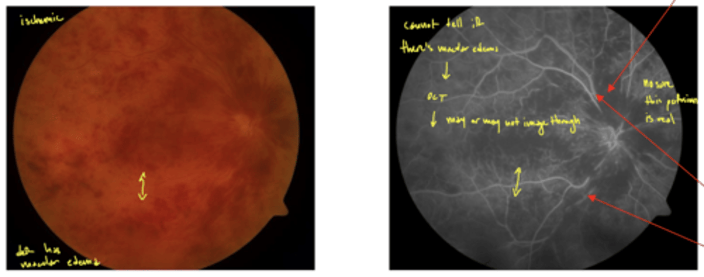 <p>FANG → hard to do early because too much blood it covers everything</p><p>may need to use OCT to see if there's macular edema</p><p>image - ischemic CRVO that shows FANG (low perfusion)</p>