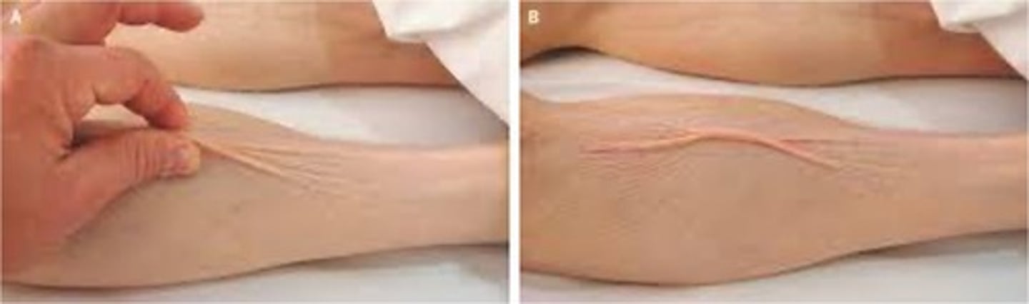 <p>tenting of the skin on the hand can signify ____</p>