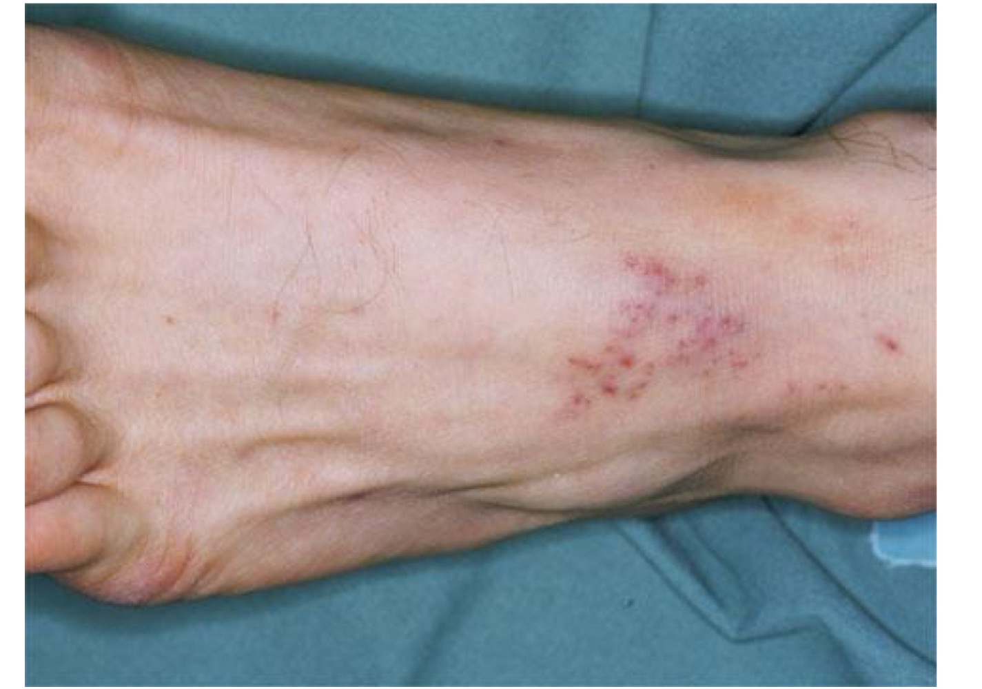 <p>what type of skin lesion is this? </p>