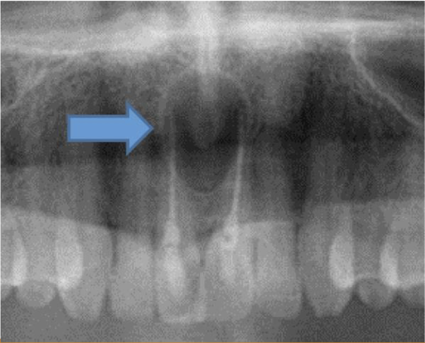 <p>A 52 year old presenting with a cystic swelling in midline in the anterior region of palate. Provide differential diagnosis</p>