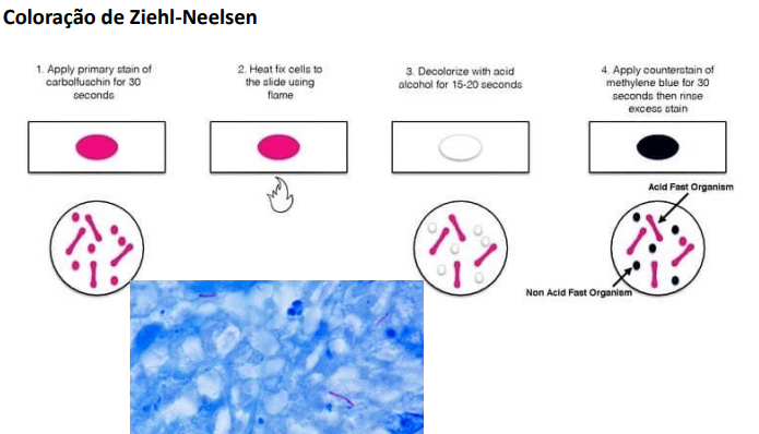 <p>Coloração de Ziehl-Neelsen</p>