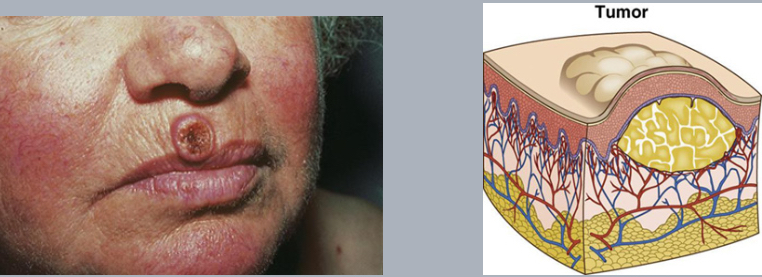 <p>tumor</p>