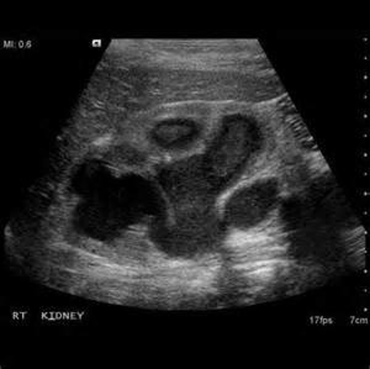 <p>1. urologic emergency (pus in kidney), a suppurative infection of the upper urinary system (need to be on IV, and antibiotics)</p><p>2. An infection</p>