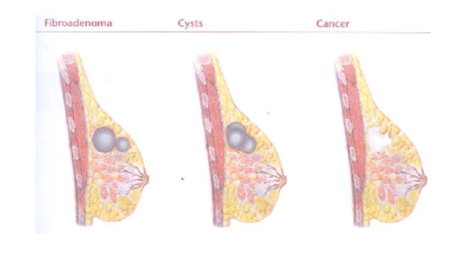 <p>Define Condition:</p><p>Common BENIGN breast tumor</p><p>-Hx: Teens to early 20s</p><p>-Sx:</p><p>&gt; Breast Pain</p><p>&gt; Breast "Lumps" (bilateral &amp; multifocal)</p><p>-PE: Solid, Firm, Round, Rubbery, Mobile; May enlarge in pregnancy (discomfort)</p><p>-Prog: Subtypes w/ more malignancy potential</p><p>&gt; Sclerosing adenosis</p><p>&gt; Epithelial hyperplasia</p>