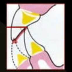 <p>the path folled by incisal edge of lower teeth from maximum intercuspation to edge-to-edge occlusion </p>