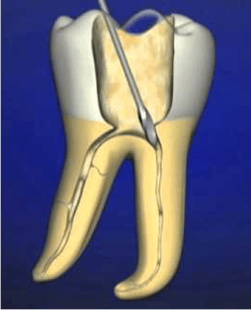 <p>•You will use #2 and 3</p><p>•Comes in sizes 1-6</p><p>•Enlarges the coronal portion of the canal for bulk removal of tooth structure</p><p>•Used for orifice shaping prior to instrumentation</p>