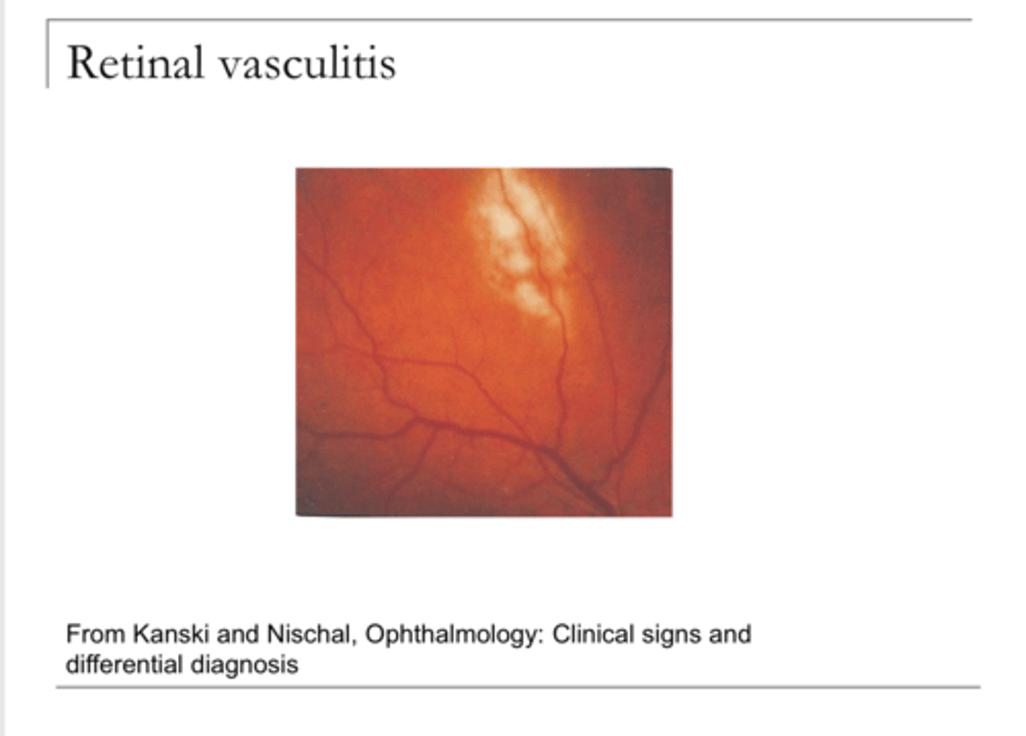 <p>Syphilis -- Retinal Vasculitis (Pic)</p>